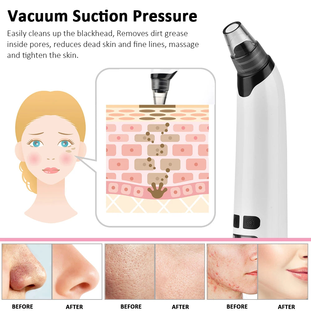 Electric Blackhead Remover - USB Rechargeable Pore Vacuum