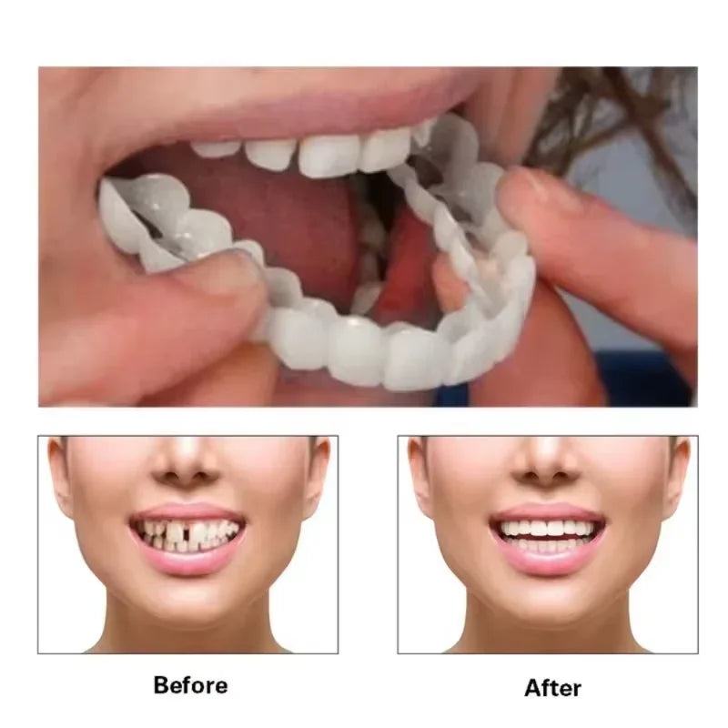 Snap-On Veneers - Temporary Tooth Whitening Kit