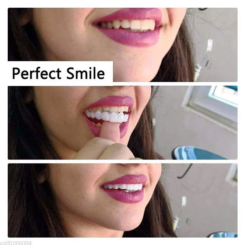 Snap-On Veneers - Temporary Tooth Whitening Kit