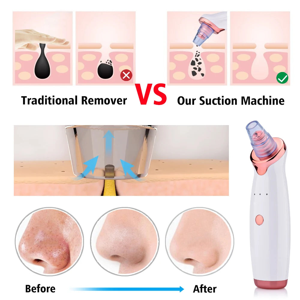 Multifunction Blackhead Remover - 5 Probes Acne Suction Tool