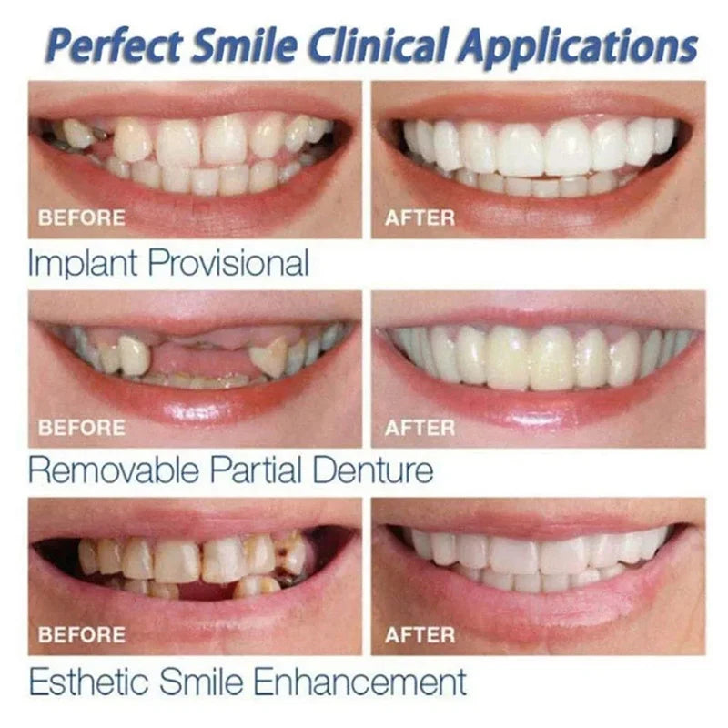 Snap-On Veneers - Temporary Tooth Whitening Kit