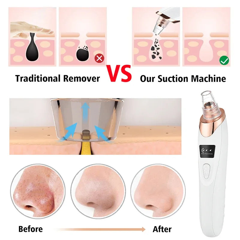 Blackhead Remover - 5 Heads Deep Cleansing Pore Vacuum