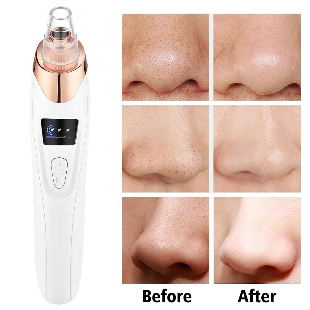 Blackhead Remover - 5 Heads Deep Cleansing Pore Vacuum